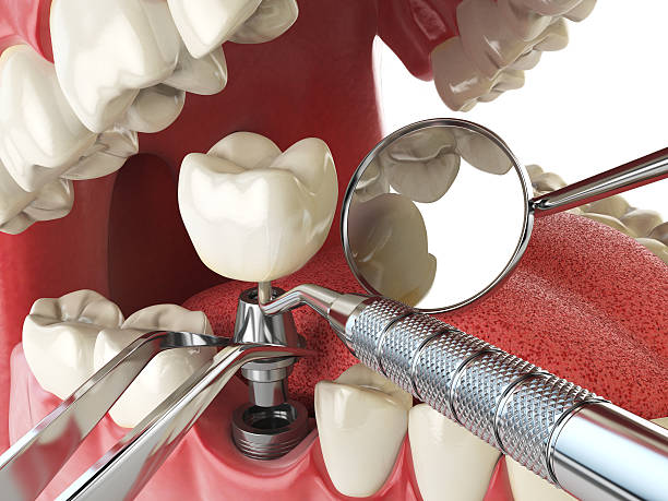 Best Broken or Chipped Tooth Repair in Clear Lake, SD